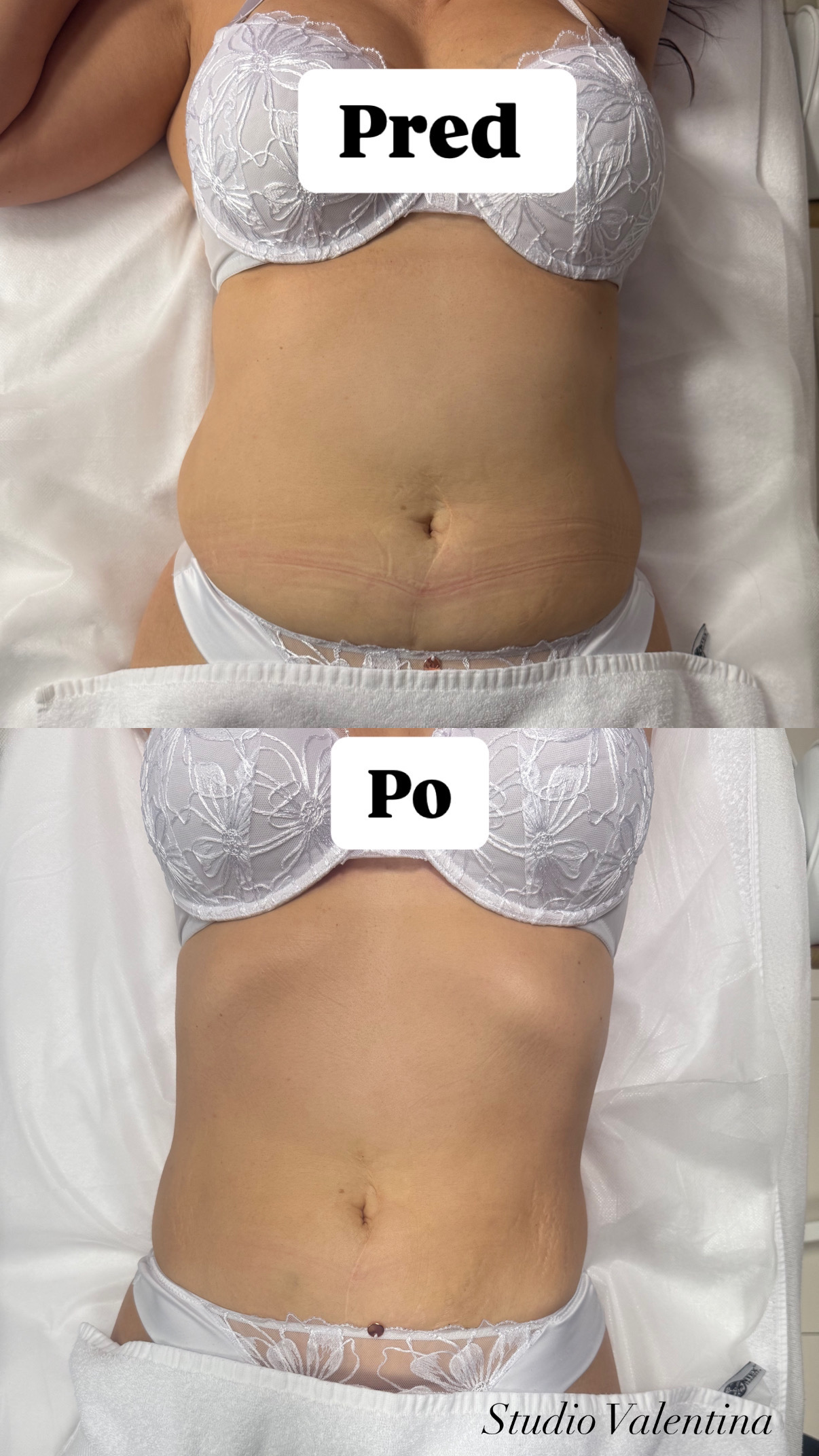 Lymfocontouring tela